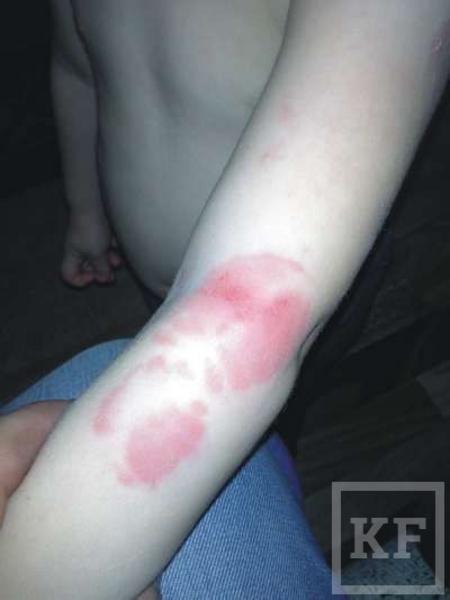 В Набережных Челнах 2-летний ребенок из детсада вернулся с гематомами