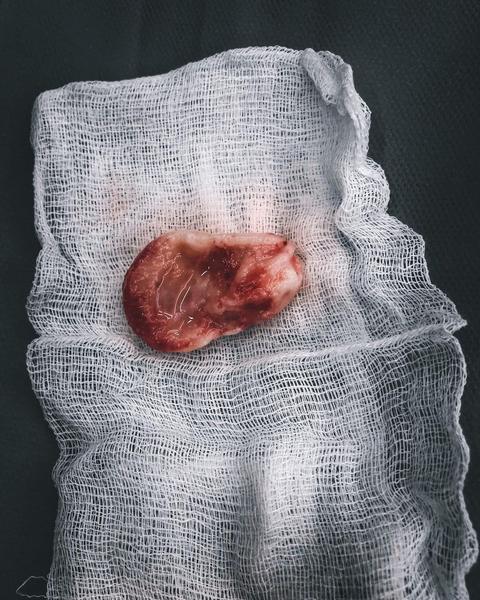 «В операционной считали секунды»: врачи Казани спасли беременную 17-летнюю девушку с тромбом в сердце