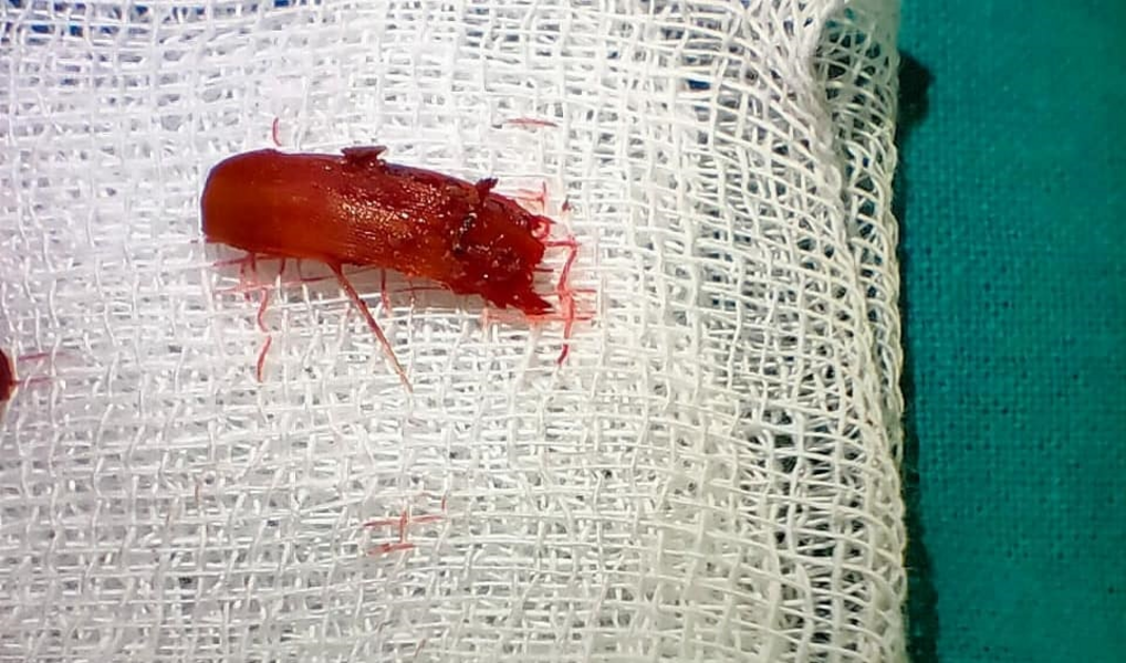 В Казани врачи достали застрявшего таракана из носа 31-летней пациентки