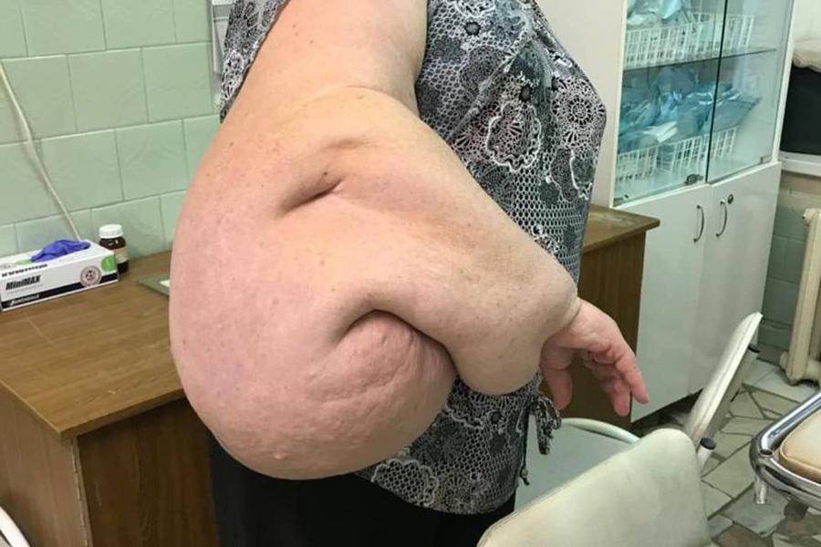 Нижнекамские хирурги провели уникальную операцию, удалив опухоль весом 20 килограммов