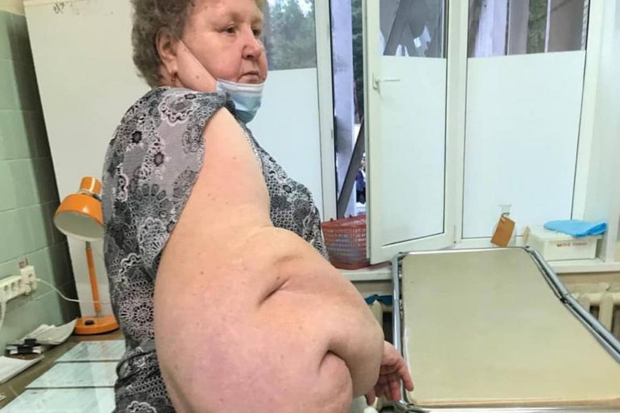 Нижнекамские хирурги провели уникальную операцию, удалив опухоль весом 20 килограммов