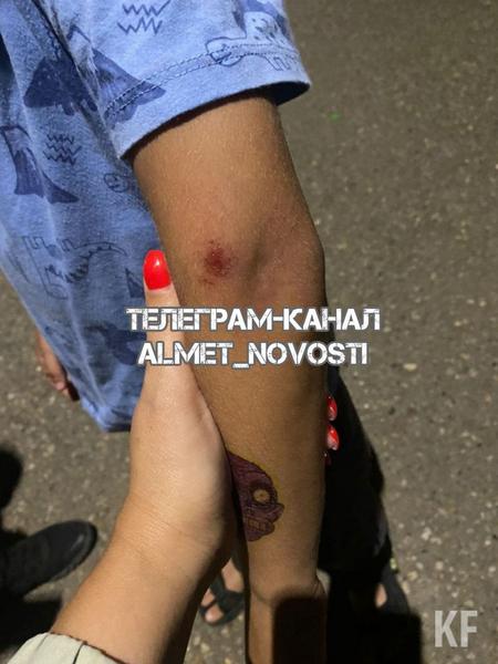 Жители Альметьевска: Бездомные собаки напали на ребенка