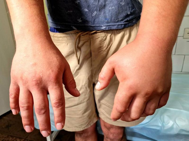 Прогулка в лес завершилась вызовом «скорой» для жителя Татарстана