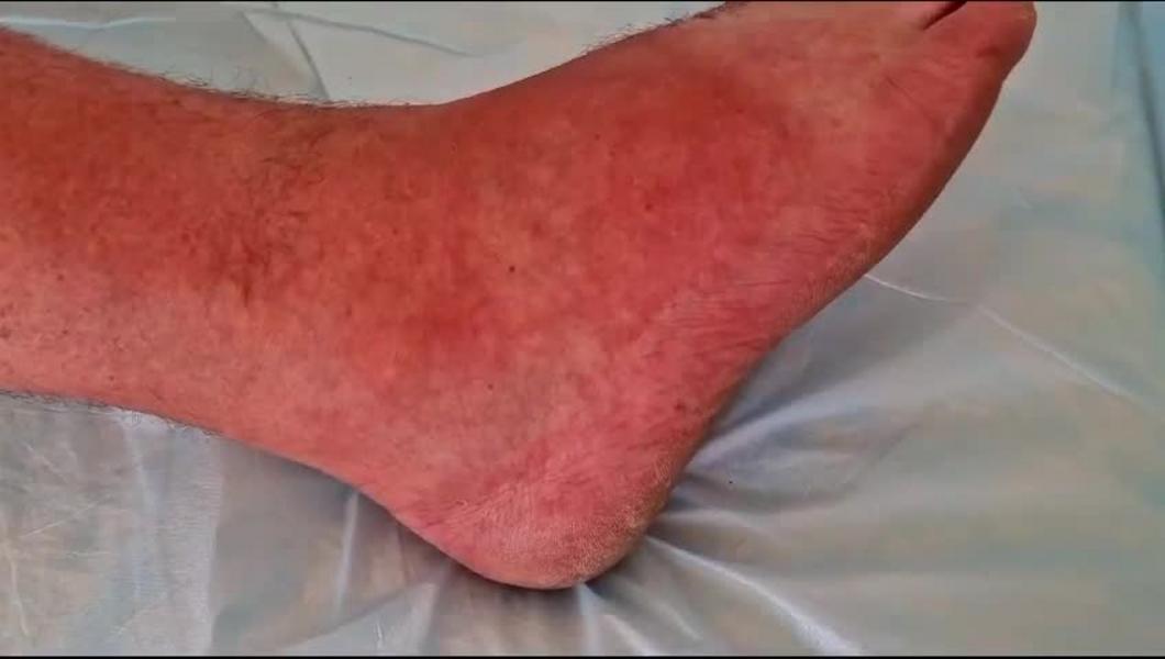 Челнинцев атаковали осы: сразу четверо обратившихся в больницу