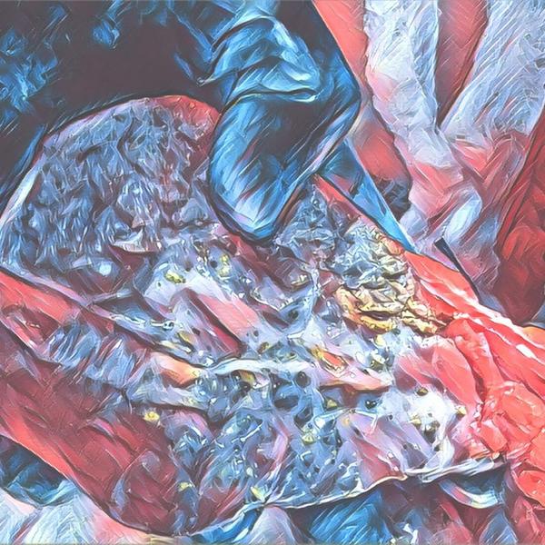 В РКБ поставили на ноги пациентку с воспалением желчного пузыря, полного камней В РКБ поставили на ноги пациентку с воспалением желчного пузыря, полного камней