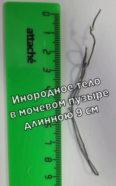 ​Из мочевого пузыря татарстанского подростка достали девятисантиметровую проволоку