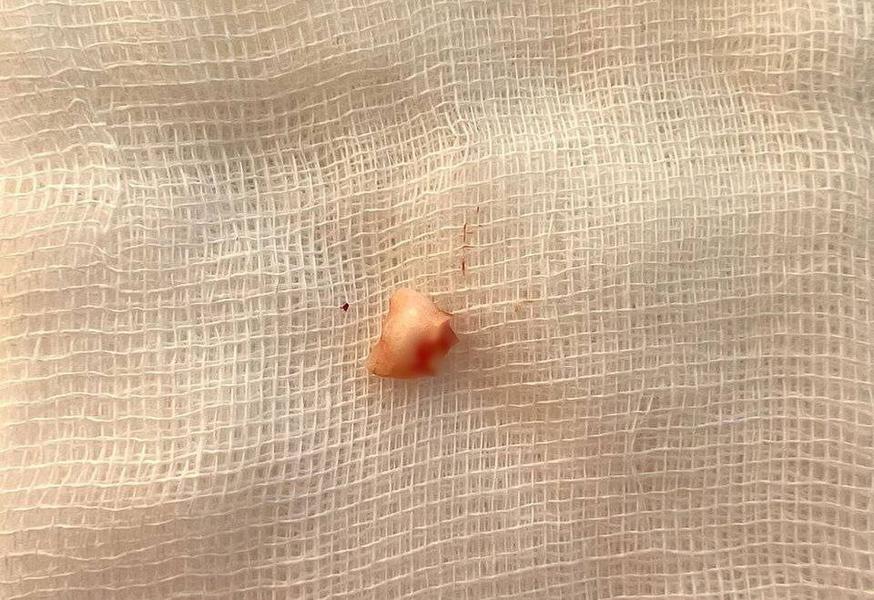 Из бронхов ребенка врачи Казани удалили зуб