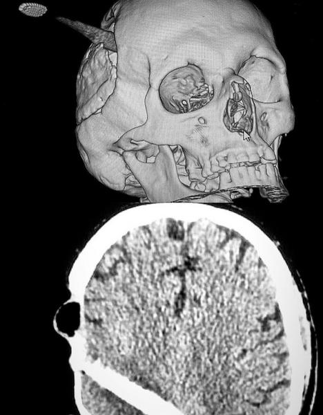Врачи из РКБ Татарстана спасли мужчину с зубной щеткой, воткнутой в мозг