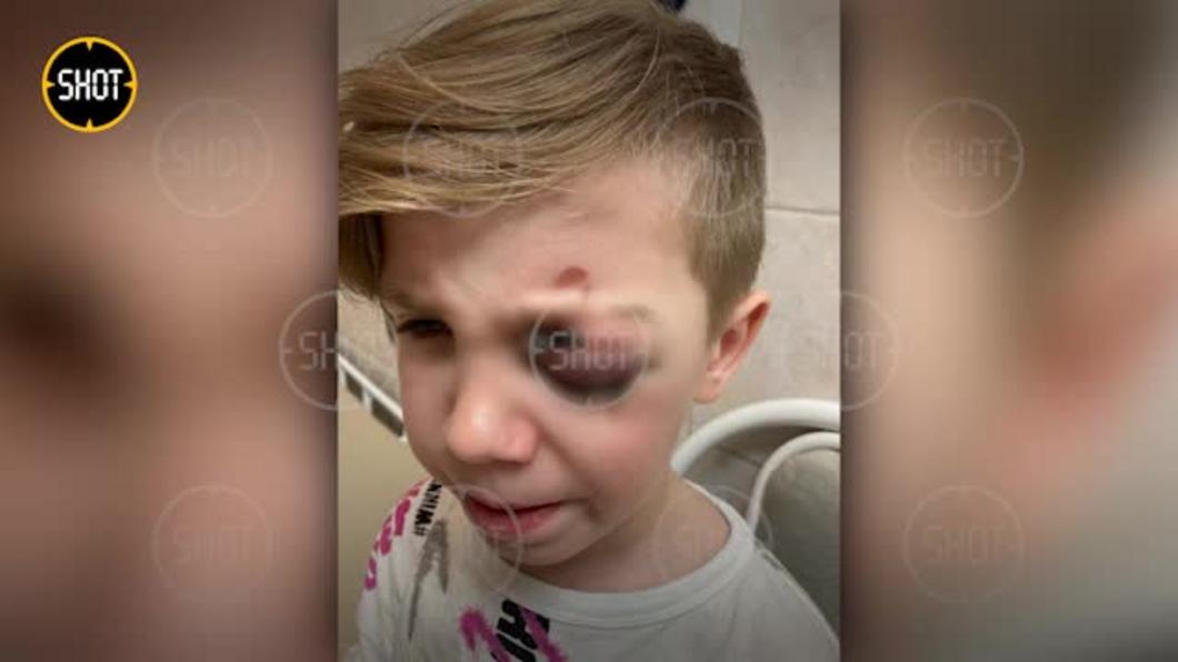 Второклассник напоролся на металлический прут в Краснодаре и чуть не лишился глаза