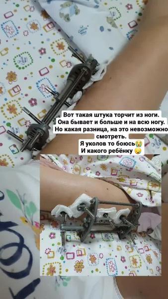 Ребенок казанской блогерши получил тяжелые травмы, катаясь на ватрушке