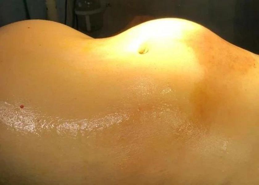 Нижнекамские врачи провели сложную операцию по удалению злокачественной опухоли