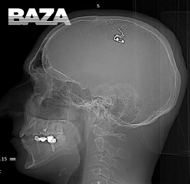 Россиянин просверлил себе голову и вшил чип