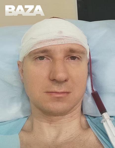 Россиянин просверлил себе голову и вшил чип