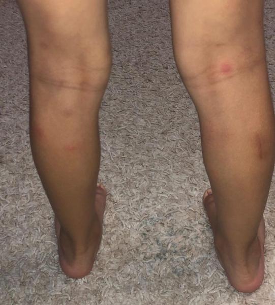 Татарстанцы страдают от укусов разъяренных комаров