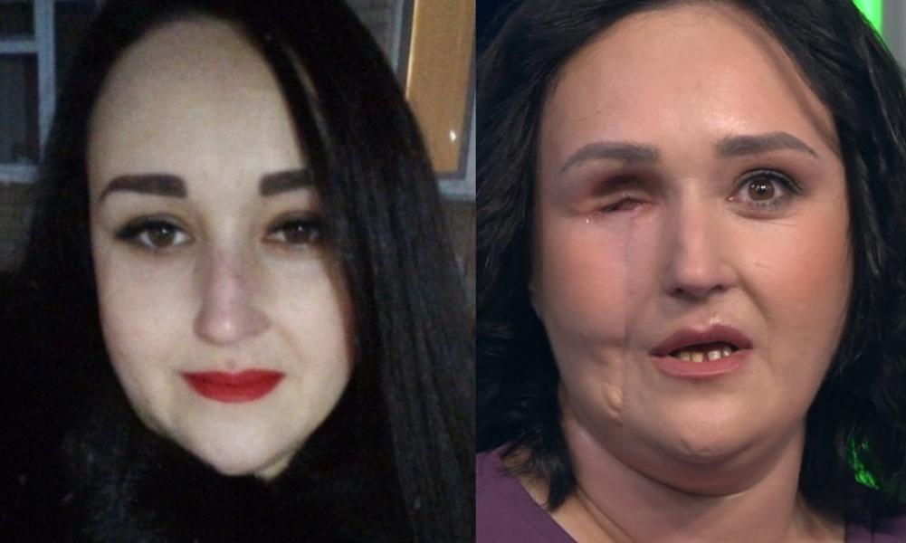 Сертификат на жилье выдали елабужской сельчанке, лицо которой обезобразил диск от бензопилы