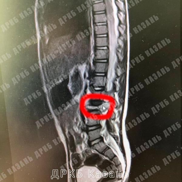 У госпитализированного в Челнах ребенка с переломом позвонка обнаружили опухоль