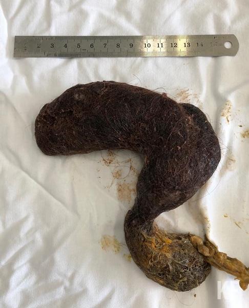 Из желудка пятилетней девочки врачи Нижнекамска извлекли метровый ком волос