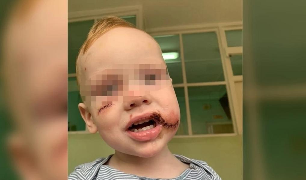 Бездомная собака изуродовала ребенку лицо