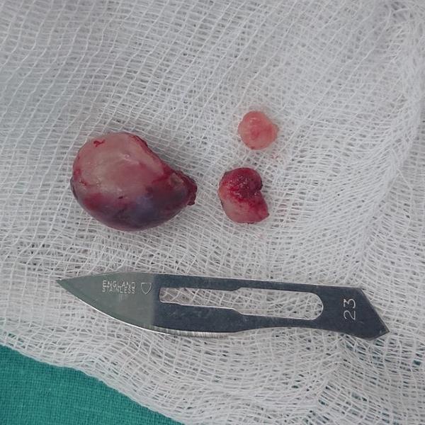 В Казани врачи РКБ спасли доктора наук, у которого опухоль перекрыла лёгкие: сначала подозревали ковид