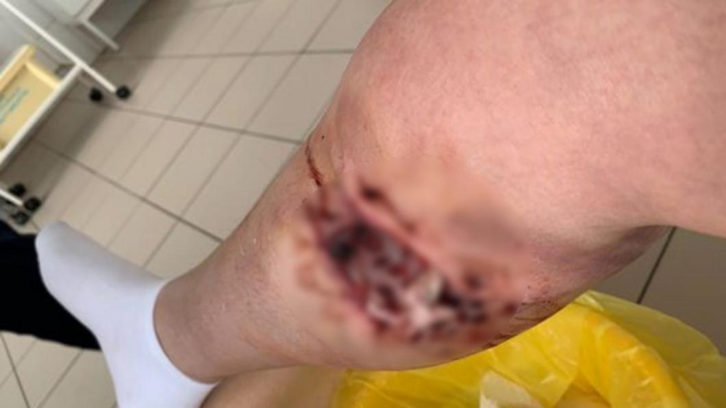 Бродячая собака так сильно истязала россиянку, что вида испугались даже медики