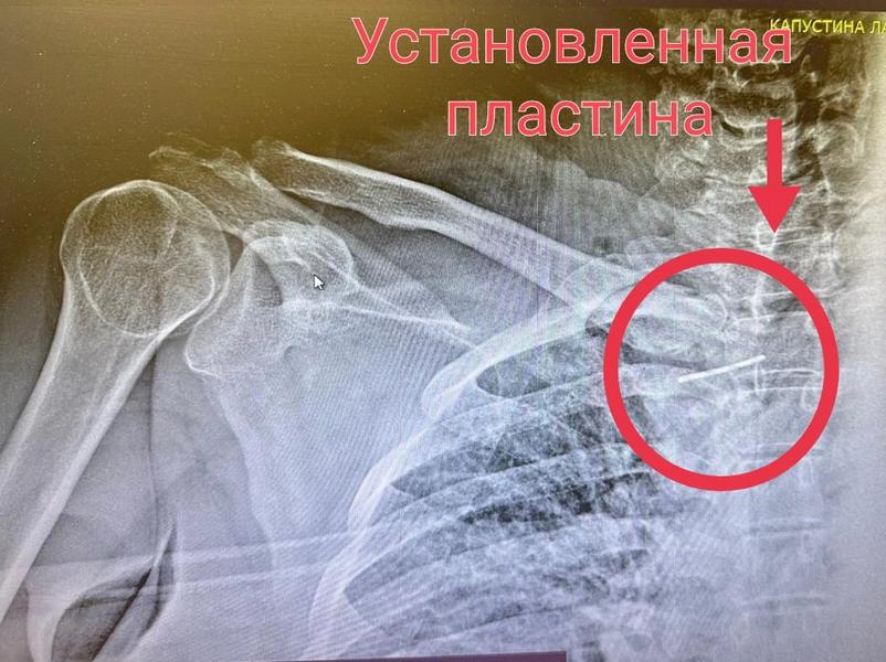 Нижнекамские травматологи прооперировали жительницу Ульяновской области с редким вывихом