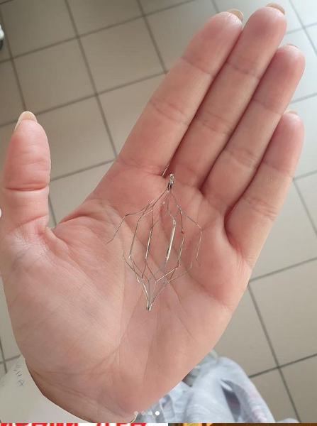 Врачи БСМП Челнов удалили у девушки из Челябинска «ловушку для тромбов»