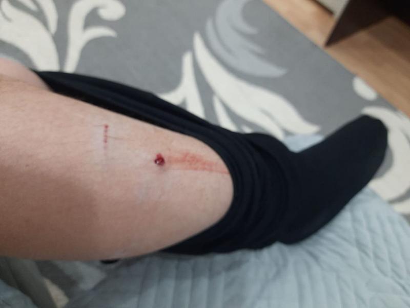 Ребенка из Альметьевска покусала собака