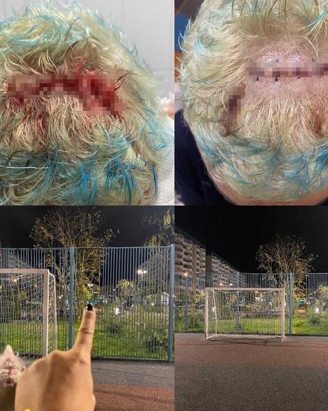 Женщина повредила голову в казанском сквере, ударившись о железные прутья забора