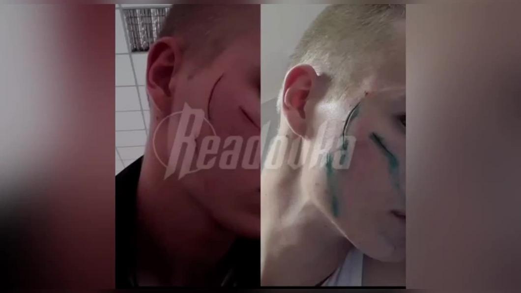 Второкурсник из Севастополя изрезал себе лицо и придумал историю о нападении