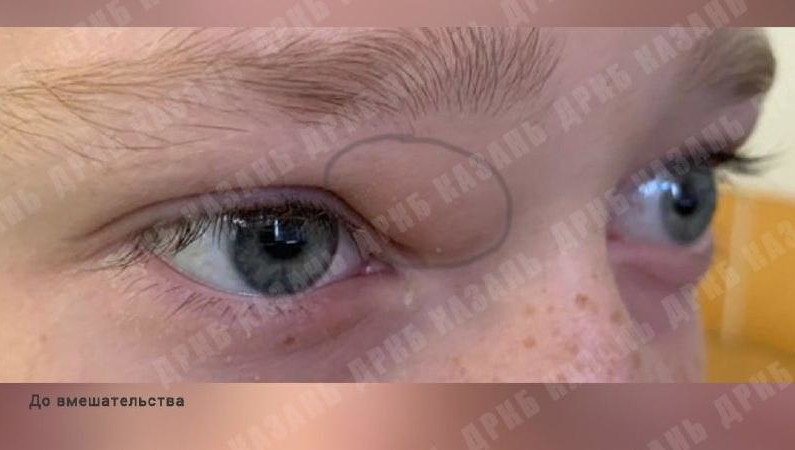 Доброкачественное образование появилось у мальчика на втором году жизни.