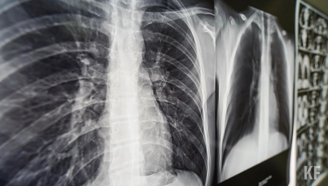 Речь идет о повреждении легких