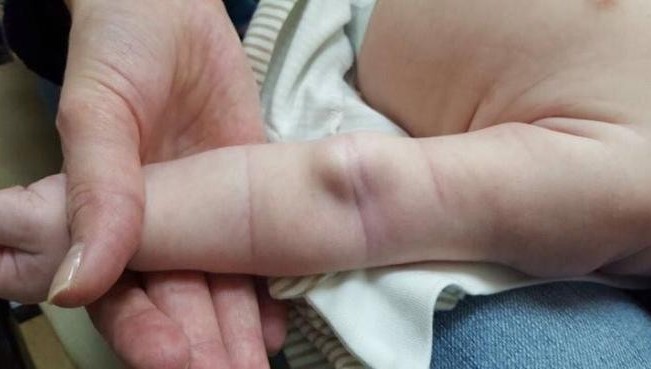 В ДРКБ врачи провели уникальную операцию по удалению врожденной аневризмы левой плечевой артерии двухмесячной малышке.  Об этом в своем в  Facebook сообщил главный врач больницы Рафаэль Шавалиев.