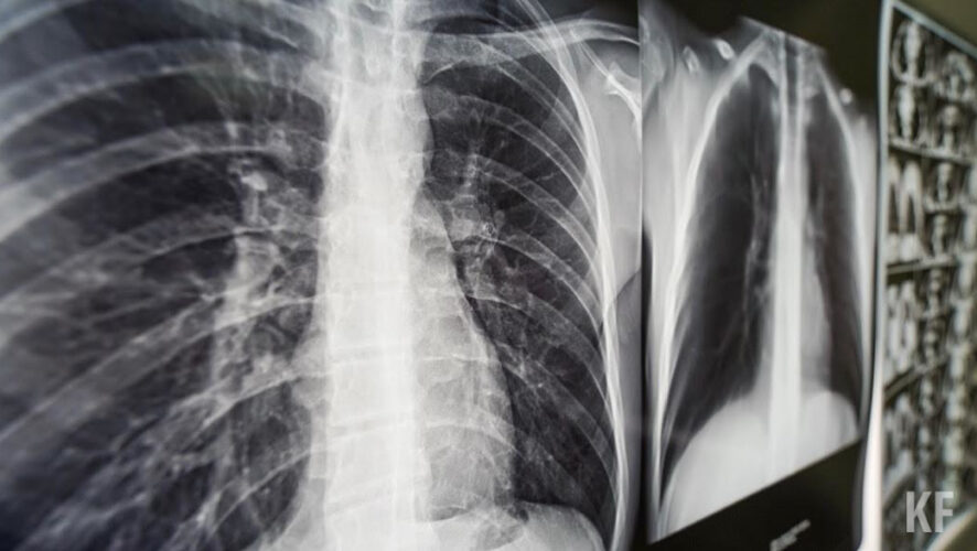 Медики рекомендуют для выявления туберкулезной инфекции сделать лабораторный тест.