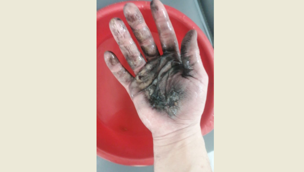 Молодой человек получил ожог второй степени.