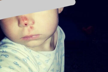 Полуторагодовалый ребенок разодрал нос на опасной горке.