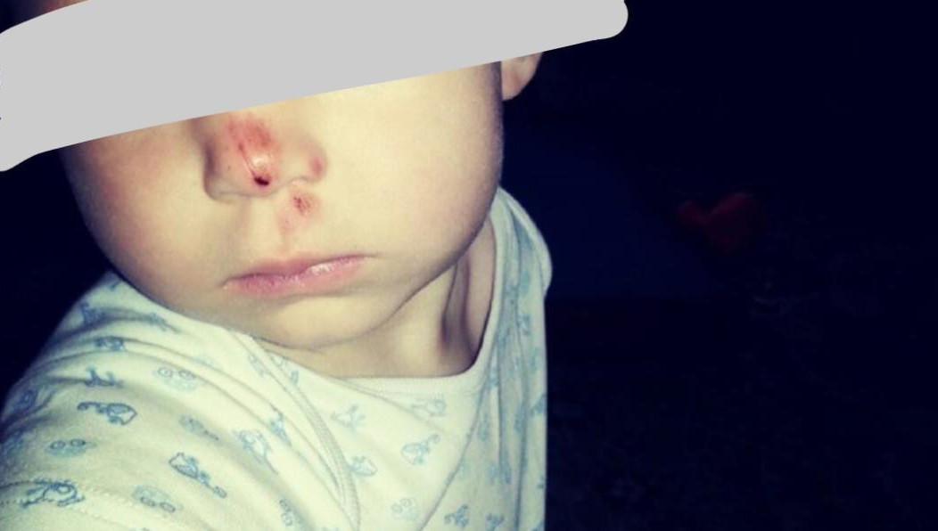 Полуторагодовалый ребенок разодрал нос на опасной горке.