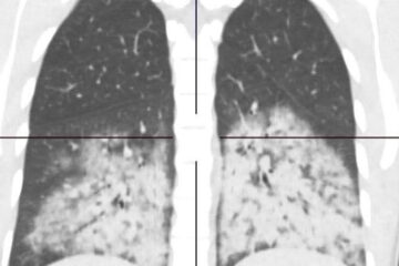 Медик показал рентгеновский снимок пристрастившейся к вейпу 20-летней девушки