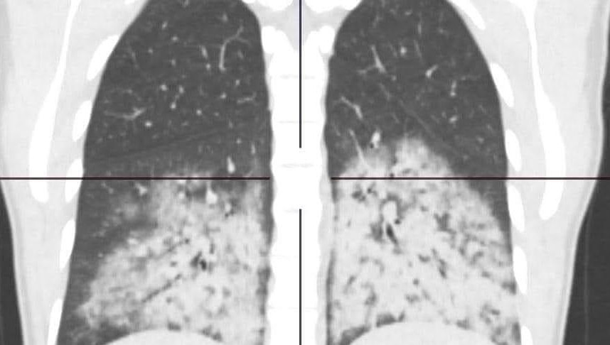 Медик показал рентгеновский снимок пристрастившейся к вейпу 20-летней девушки