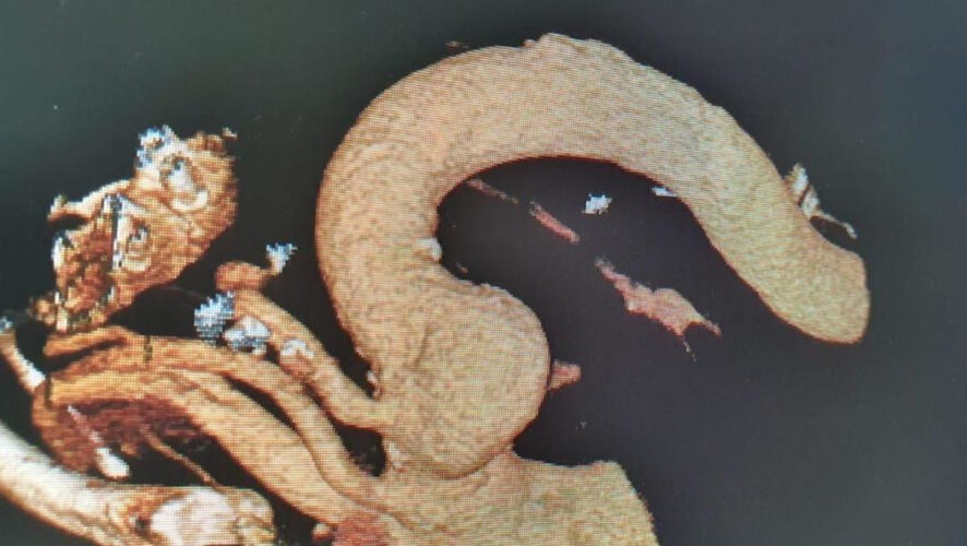 Хирурги во время операции прожгли электрической дугой дополнительные отверстия в местах соединения аорты с артериями.