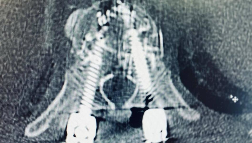 После компрессионного перелома мужчину мучила нестерпимая боль.