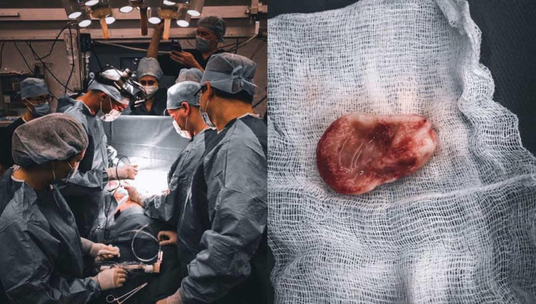 У кардиохирургов на извлечение тромба было всего 80 секунд.