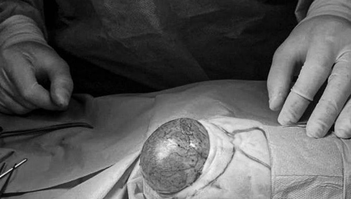 У малыша была диагностирована тератома в крестцово-копчиковой области.