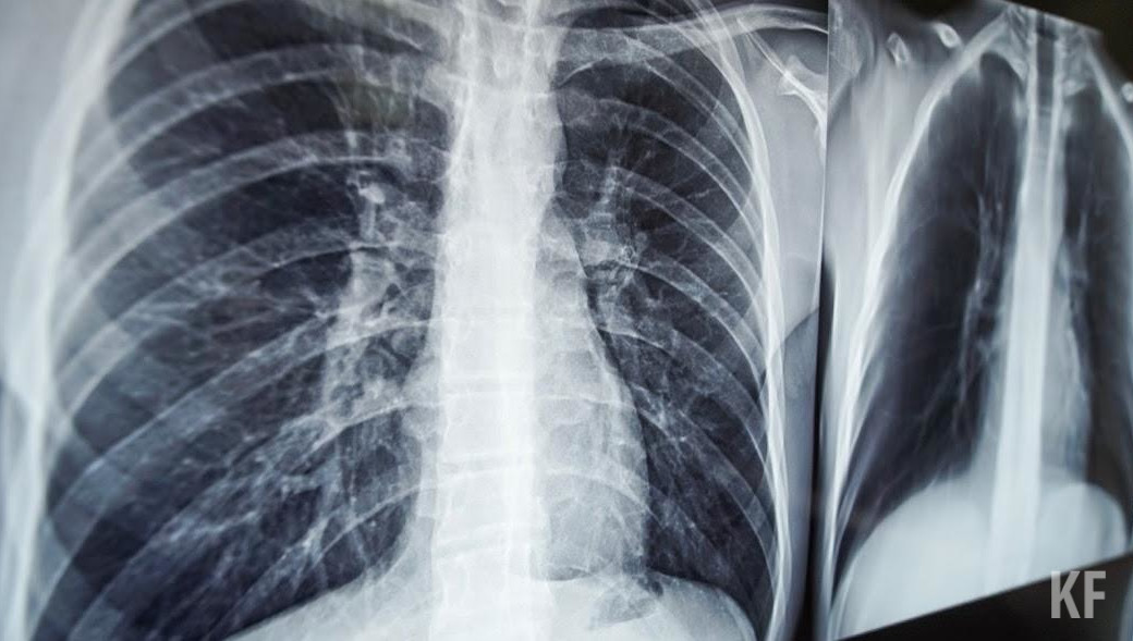 Специалисты отмечают также более высокую его заразность.