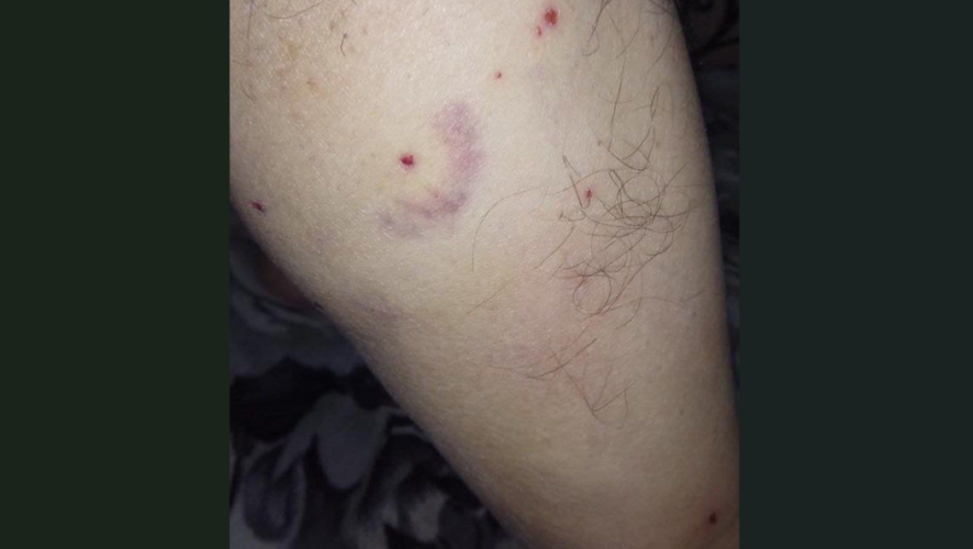 От серьезной травмы мужчину спасли толстые брюки.