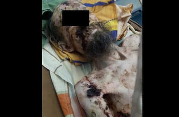 Выживший в берлоге медведя в Туве мужчина оказался больным псориазом из Казахстана.