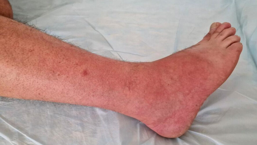 Один из ужаленных рассказал