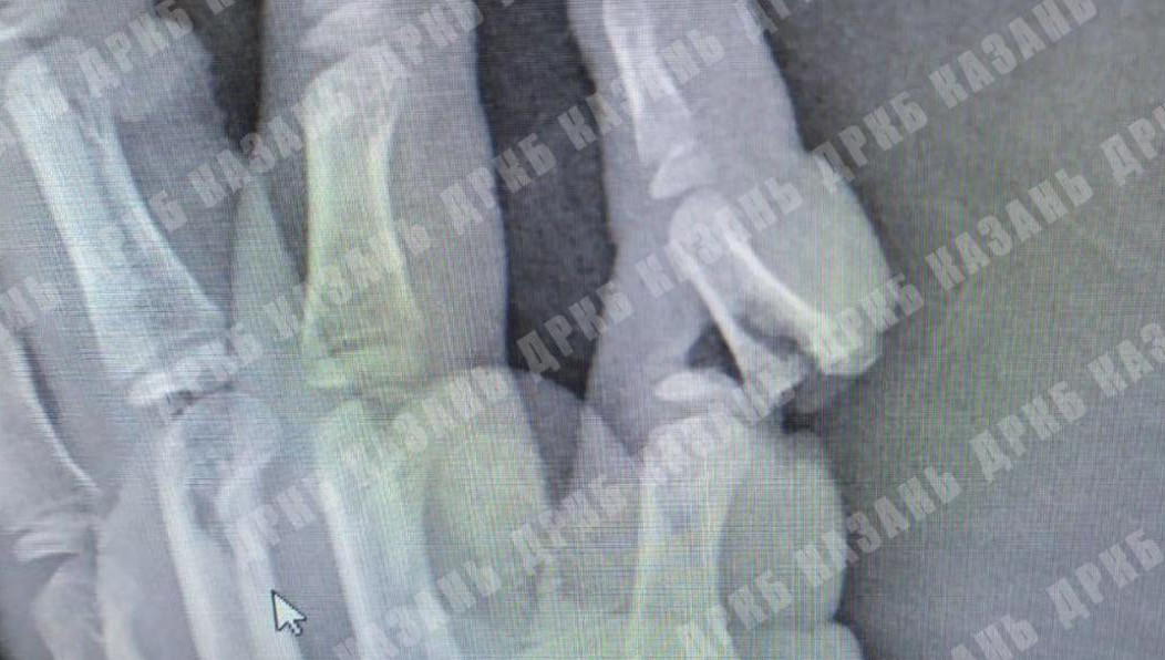 Палец держался только на лоскуте кожи.